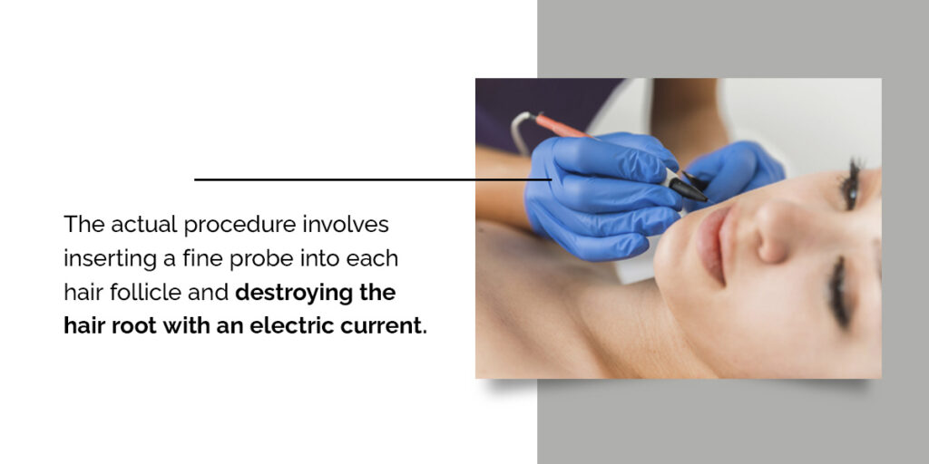 The Large Volume Electrolysis procedure with a fine probe destroying the hair root