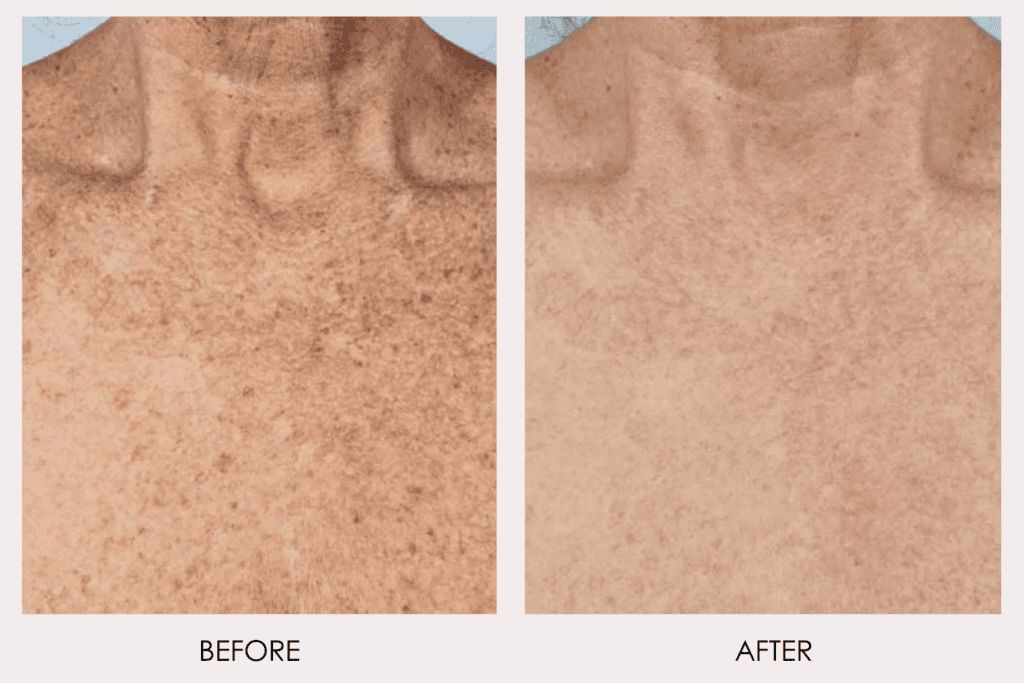 fractional resurfacing before and after 2