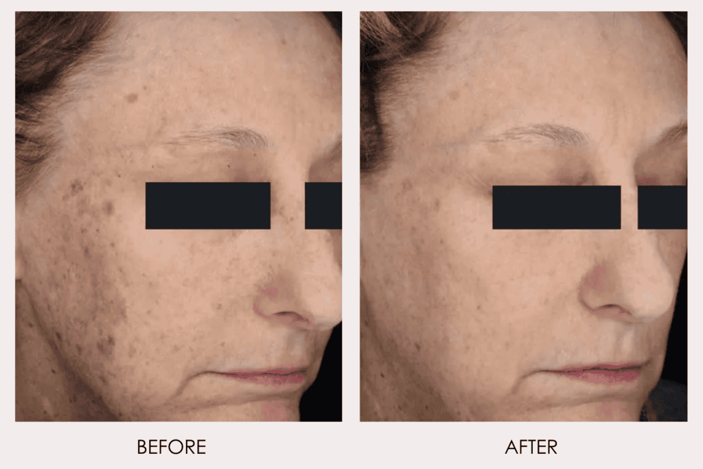 fractional resurfacing before and after 3